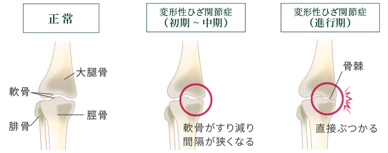 ひざ関節症のイメージ
